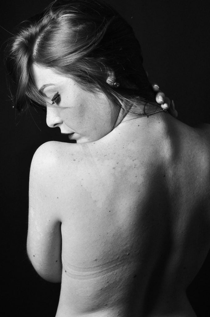 Acupuncture for Back Pain